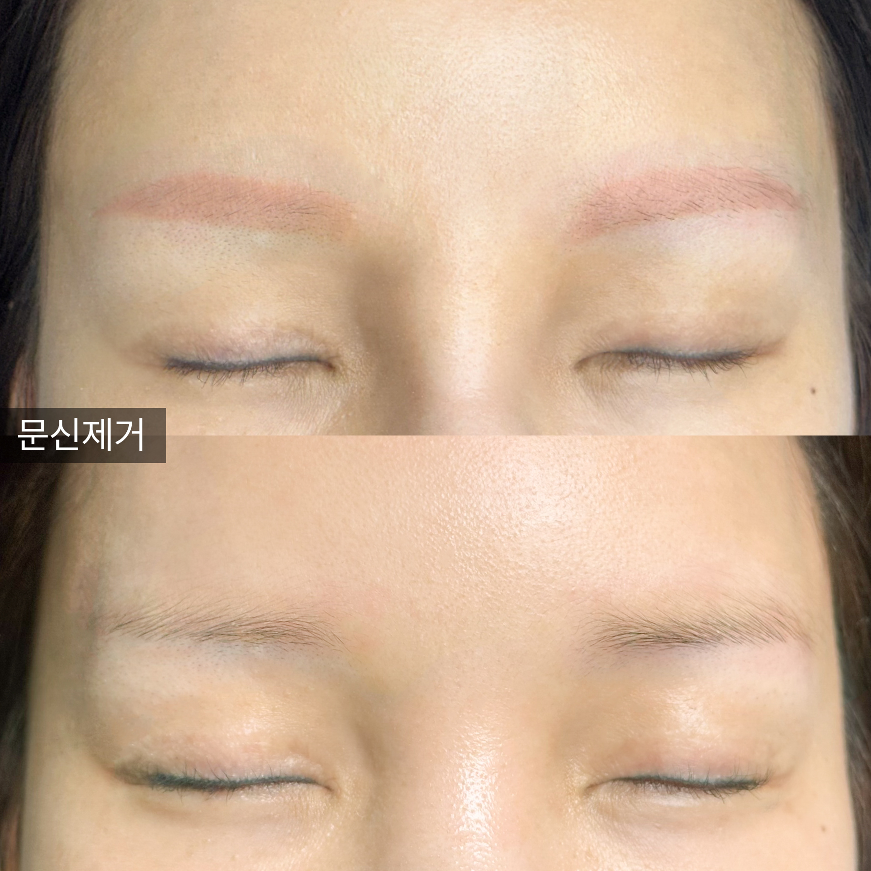 강남구 반영구/눈썹문신 폴라브로우 잔흔 제거