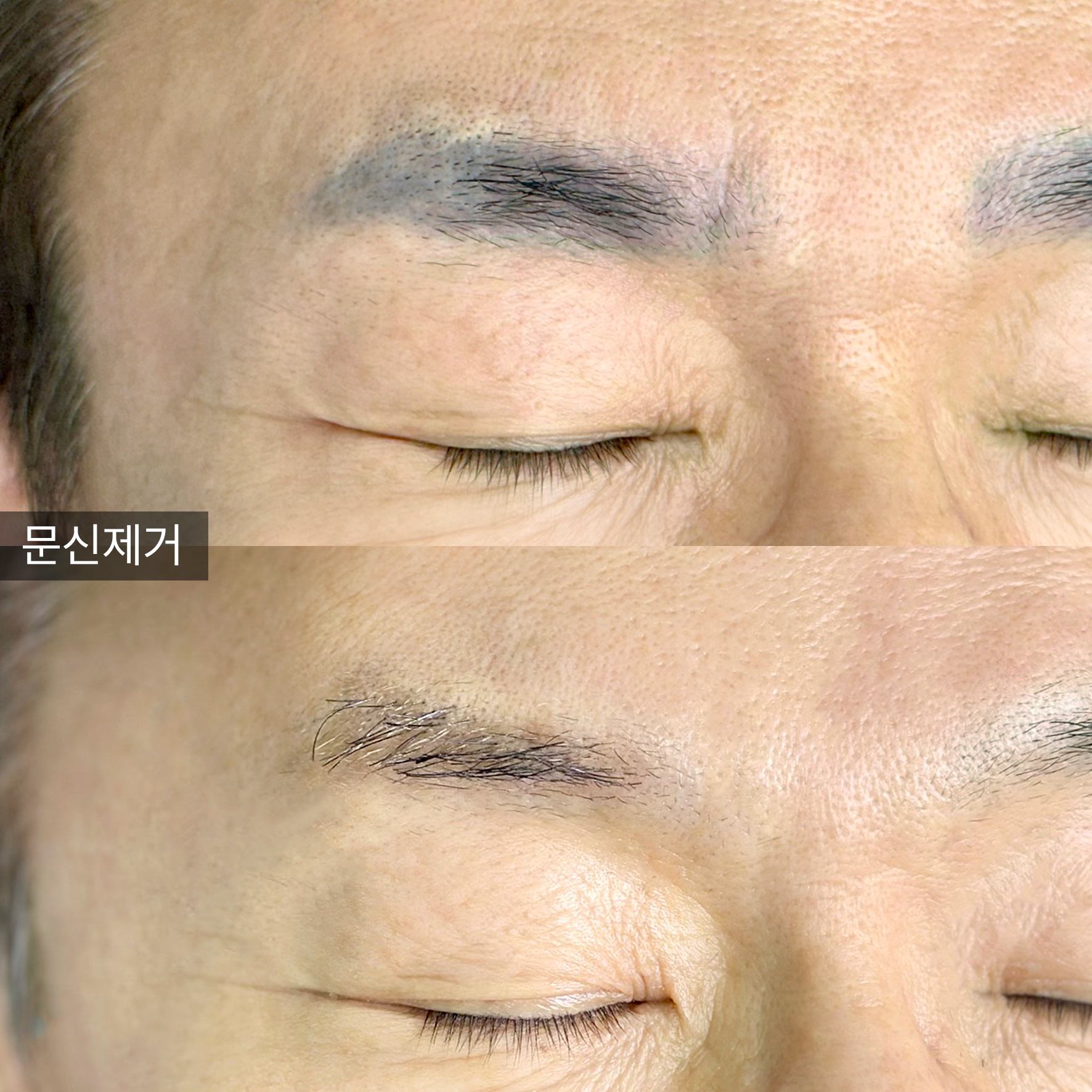 강남구 반영구/눈썹문신 폴라브로우 잔흔 제거