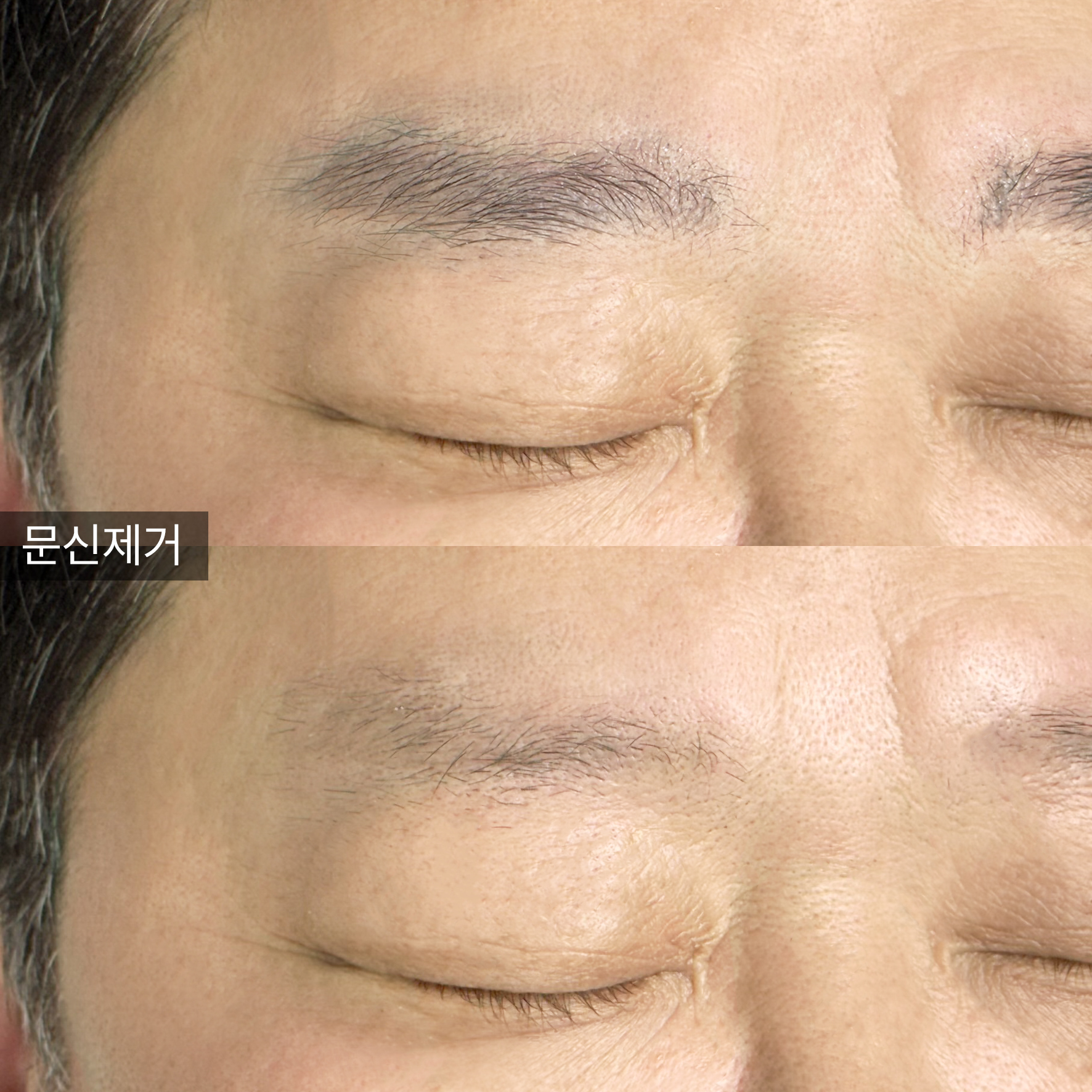 강남구 반영구/눈썹문신 폴라브로우 잔흔 제거
