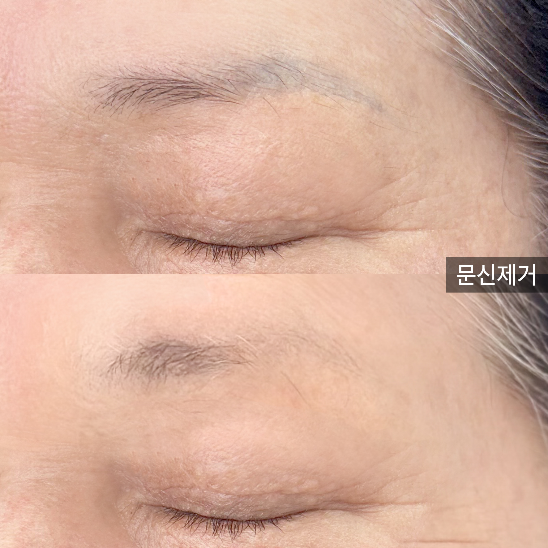 강남구 반영구/눈썹문신 폴라브로우 잔흔 제거